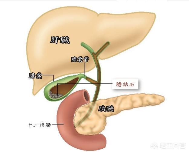 今日科普一下！胆囊藏400多颗结石,百科词条爱好_2024最新更新