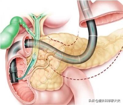 今日科普一下！胆囊藏400多颗结石,百科词条爱好_2024最新更新