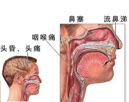 今日科普一下！流感不是普通重感冒,百科词条爱好_2024最新更新